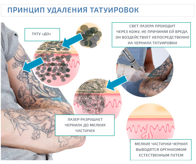 Все, что нужно знать про удаление татуировок